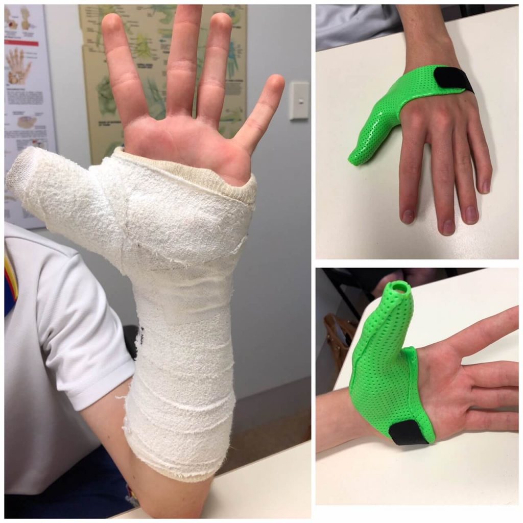 Hand Thermoplastic Splints Upper Limbs & Things