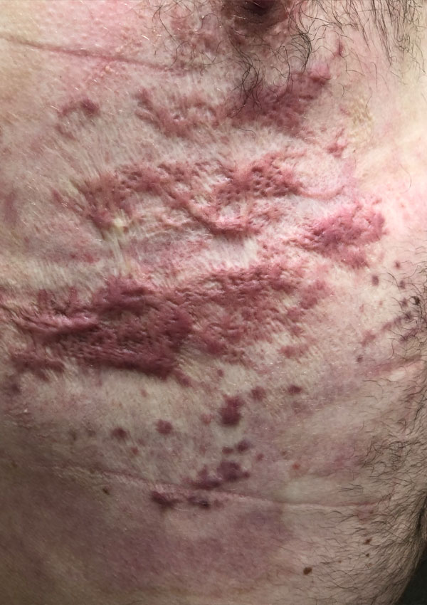 Burns Management Mackay Upper Limbs & Things